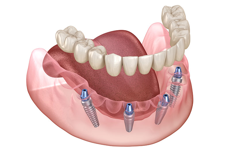 All on 4 Dental Implants in Saddle Brook
