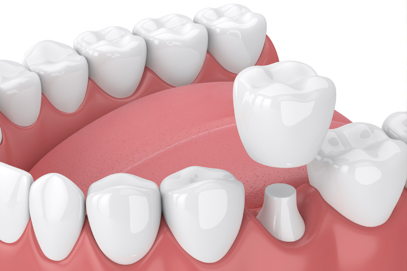 Dental Crowns in Saddle Brook