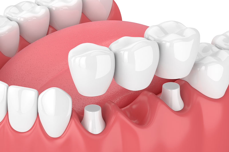 Dental Bridges in Saddle Brook