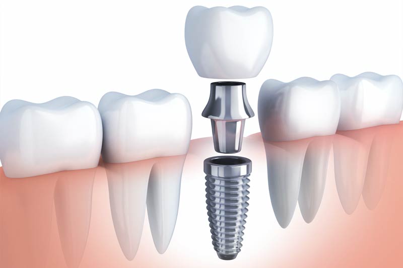 Dental Implants in Saddle Brook