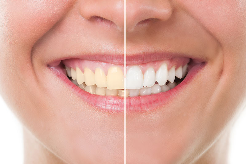 Teeth Whitening in Saddle Brook