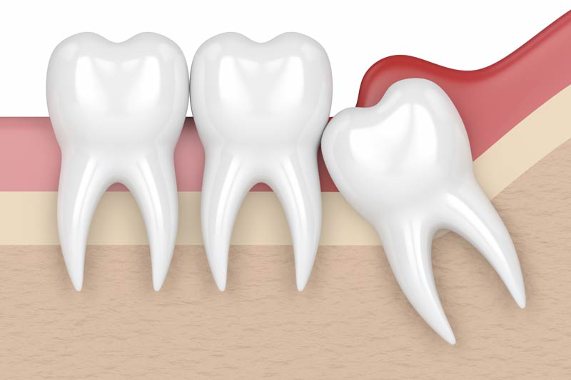 Wisdom Tooth Removal in Saddle Brook